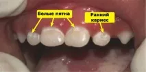 Карієс на передніх зубах лікування, карієс передніх зубів (фото) передніх
