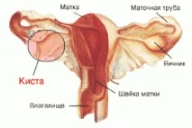 Кіста шийки матки походження захворювання, методи лікування, народна медицина шийки