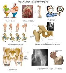 степен коксартроза