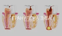 Лікування гранульоми на корені зуба, причини, симптоми, видалення гранульоми гранульоми