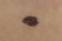 лицето лентиго