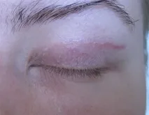 блефаропластика след