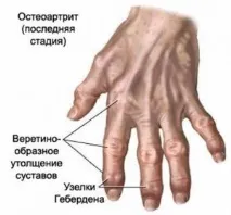 пикочна киселина пуринови основи