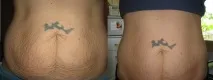 помага мезоролерът