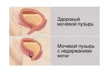 инконтиненция урината