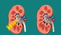 Операція на нирки при камені, причини, реабілітація операція