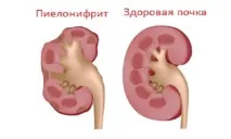 Пієлонефрит - симптоми, причини, дієта та лікування народними засобами дієта