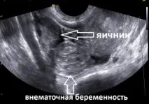 извънматочна извънматочна