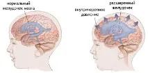 повишено вътречерепно повишено