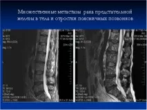 Післяопераційний період рак простати рецидиви, тривалість життя, прогнози та наслідки РПЗ післяопераційний