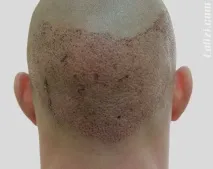 коса трансплантация