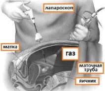 матки