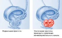 лечение лечение