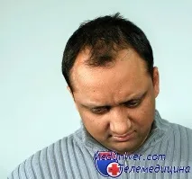 плешивост начин живот