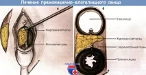 фистула признаци