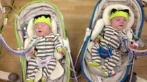 Сіамські близнюки – одне життя та одне тіло на двох сіамські