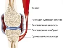 Синовіт колінного суглоба симптоми та всі види лікування синовіт