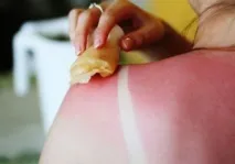 слънчеви бани изгаряне