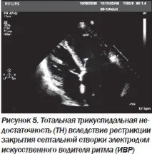 Сучасна ехокардіографічна оцінка правого шлуночка в клінічній практиці, Інтернет-видання шлуночка