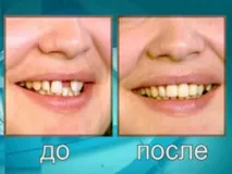 Тортоаномалія симптоми, ознаки, діагностика та лікування ознаки
