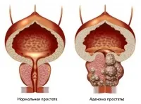 трансуретрална