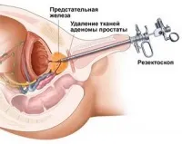 пикочния мехур