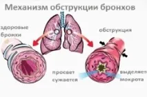 хроничен бронхит инжекции