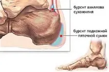 Запалення ахіллового сухожилля запалення