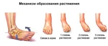 Запалення ахіллового сухожилля запалення