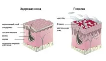 симптоми вулгарис