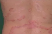 вулгарис вулгарис