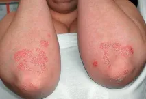 причини псориазис