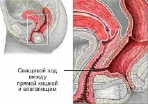 фистулни вродени
