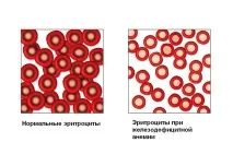 Хлороз у дітей дітей