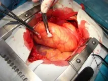 Tratamentul chirurgical al lipomului gigant intrapericardic al inimii