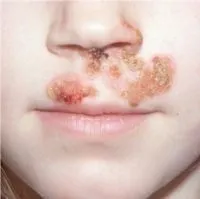 кожни заболявания