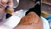 колянната става лечение
