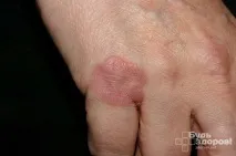симптоми симптоми