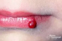 лечение симптоми