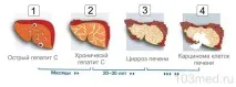 Гепатит С – лікування, як передається, симптоми та перші ознаки лікування