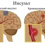 Інсульт - Опис - Журнал Здоров’я інсульт