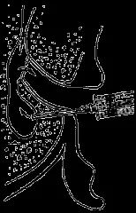 Hearing Improving, Treatment of caries в atticoantral region of the middle ear with region