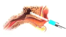 Hearing Improving, Treatment of caries в atticoantral region of the middle ear with atticoantral