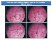 пикочния мехур