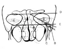 Hearing Improving, Treatment of caries в atticoantral region of the middle ear with treatment
