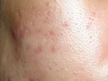 следите акне супени лъжици