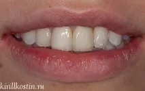зубів
