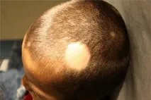 алопеция деца детска възраст