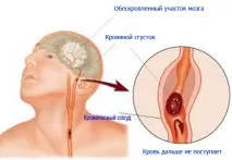 Артеріовенозна мальформація судин головного, спинного мозку, легень, симптоми, лікування, артеріовенозна