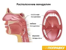 тонзилит остър